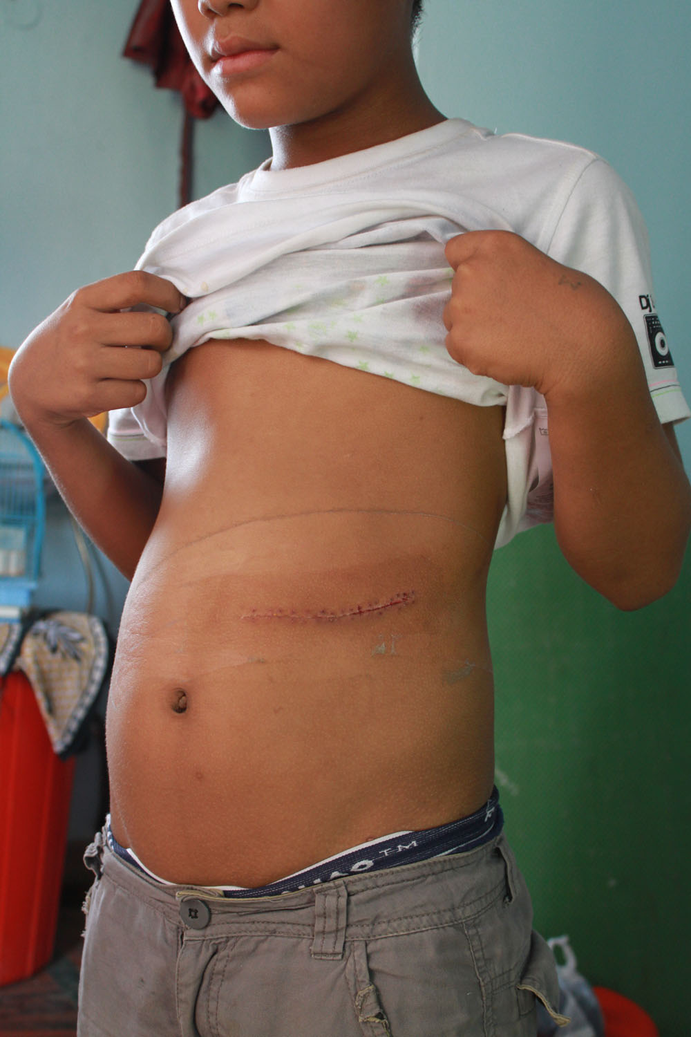 The witness in W’s case with slashed abdomen. The stiches opened on a day before he was photographed.