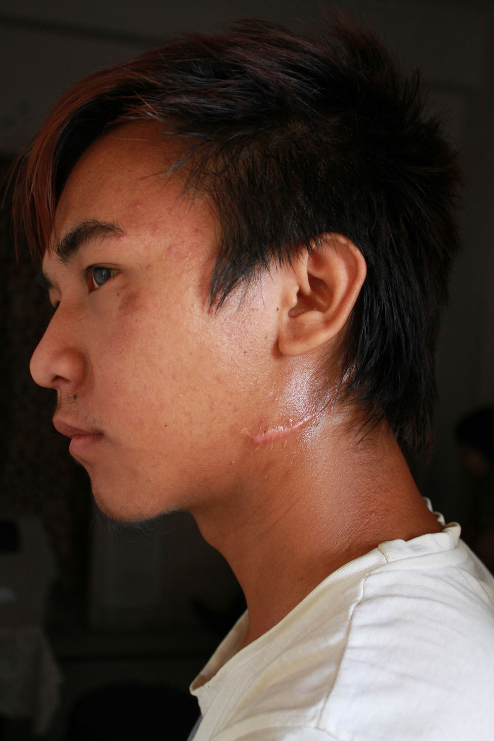 Tizano, 18 year old orphan living alone in Delhi, showing the scar in his neck. 